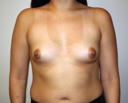 Breast Augmentation Before & After Patient #1716