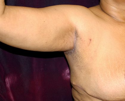 Arm Lift Before & After Patient #781