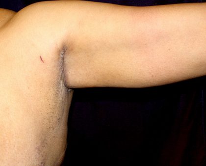 Arm Lift Before & After Patient #781