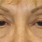 Blepharoplasty Before & After Patient #743