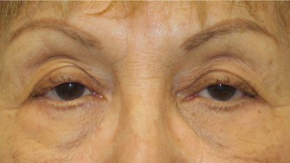 Blepharoplasty Before & After Patient #743