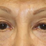 Blepharoplasty Before & After Patient #743