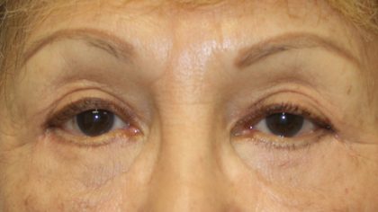 Blepharoplasty Before & After Patient #743