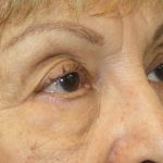 Blepharoplasty Before & After Patient #743