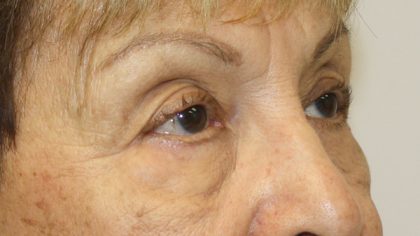 Blepharoplasty Before & After Patient #743