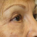 Blepharoplasty Before & After Patient #743