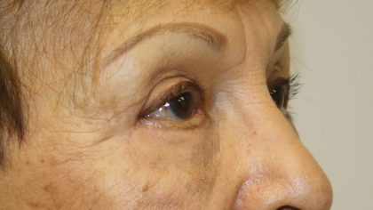 Blepharoplasty Before & After Patient #743