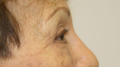 Blepharoplasty Before & After Patient #743