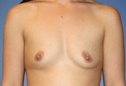Breast Augmentation Before & After Patient #1460