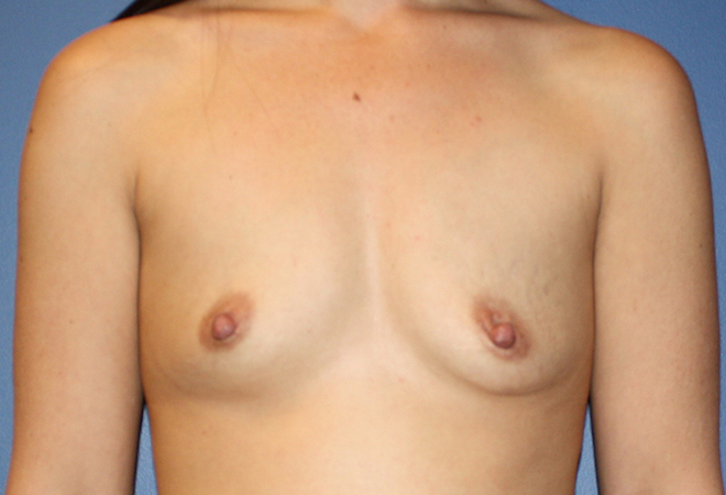 Breast Augmentation Before & After Patient #1460