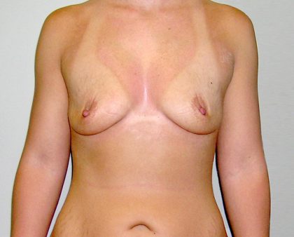 Breast Augmentation Before & After Patient #1579