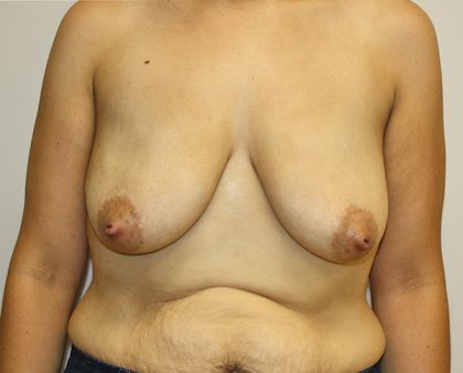 Breast Lift Before & After Patient #827