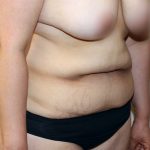 Tummy Tuck Before & After Patient #535