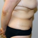 Tummy Tuck Before & After Patient #535