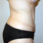 Tummy Tuck Before & After Patient #535