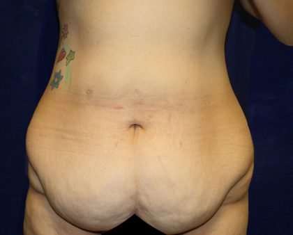 Tummy Tuck Before & After Patient #563