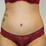 Tummy Tuck Before & After Patient #563