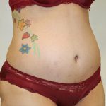 Tummy Tuck Before & After Patient #563