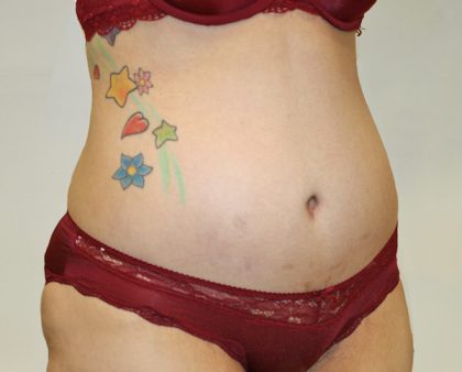 Tummy Tuck Before & After Patient #563