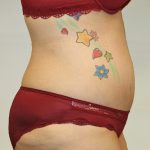 Tummy Tuck Before & After Patient #563