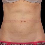 CoolSculpting Before & After Patient #1898