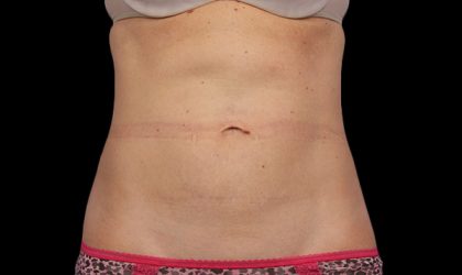 CoolSculpting Before & After Patient #1898