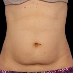 CoolSculpting Before & After Patient #1898