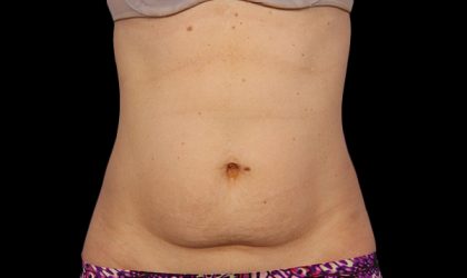 CoolSculpting Before & After Patient #1898