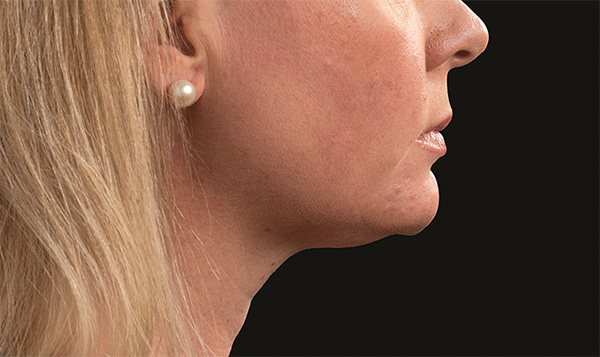 Neck Liposuction Before & After Patient #1912