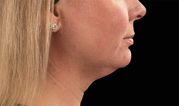 Neck Liposuction Before & After Patient #1912