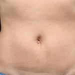 CoolSculpting Before & After Patient #1901