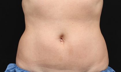 CoolSculpting Before & After Patient #1901