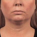 CoolSculpting Before & After Patient #1912