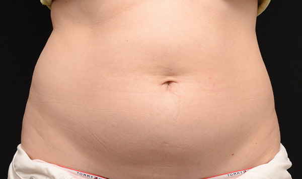 CoolSculpting Before & After Patient #1902