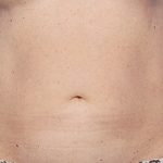 CoolSculpting Before & After Patient #1903