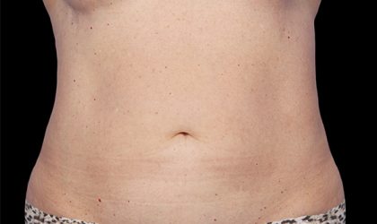 CoolSculpting Before & After Patient #1903