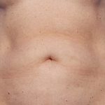 CoolSculpting Before & After Patient #1903