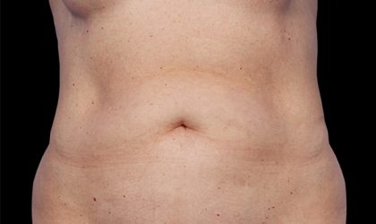 CoolSculpting Before & After Patient #1903