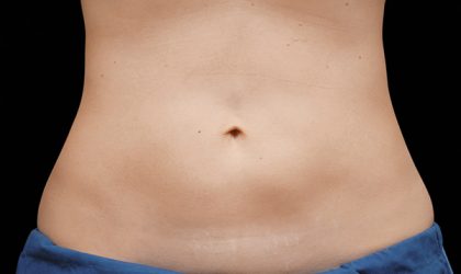 CoolSculpting Before & After Patient #1910