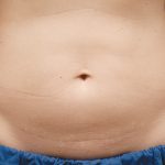 CoolSculpting Before & After Patient #1910