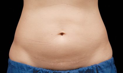 CoolSculpting Before & After Patient #1910