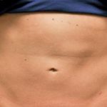 CoolSculpting Before & After Patient #1911