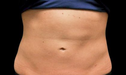 CoolSculpting Before & After Patient #1911