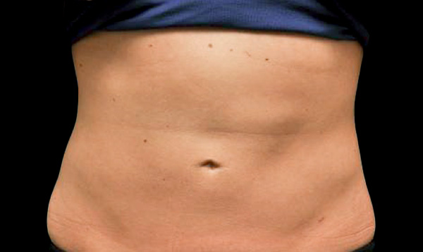 CoolSculpting Before & After Patient #1911
