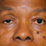 Blepharoplasty Before & After Patient #1884