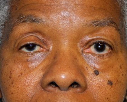 Blepharoplasty Before & After Patient #1884