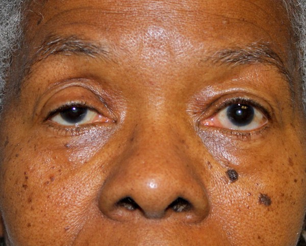 Blepharoplasty Before & After Patient #1884