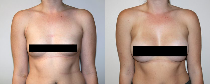 Los Altos Breast Augmentation  Choosing the Best Implant Size