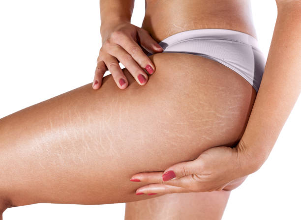 Thigh Lift Los Angeles