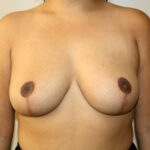 Breast Reduction Before & After Patient #2350